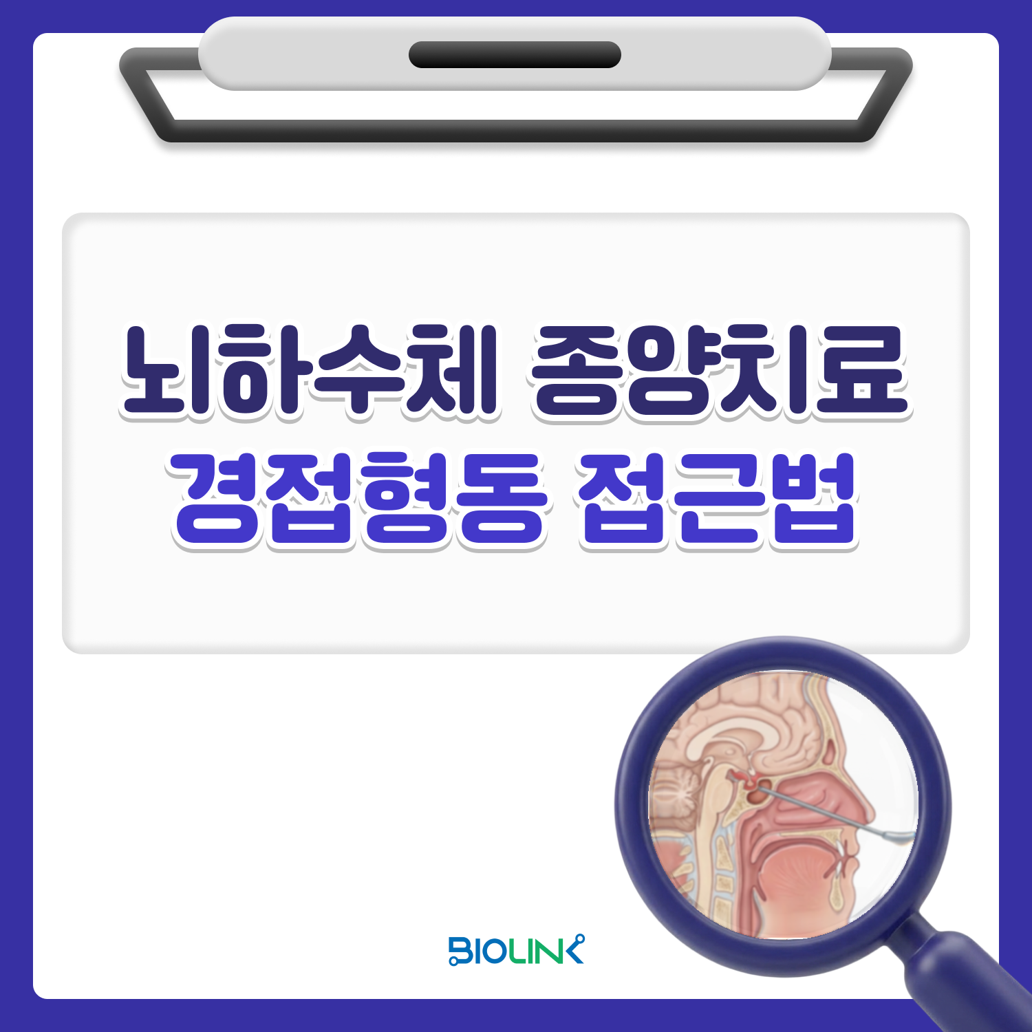 경접형동 접근법(TSA)
